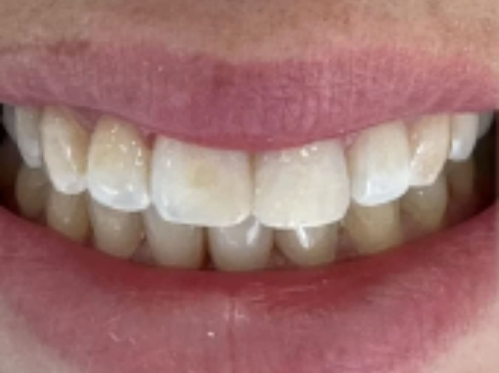 Depois — restauração estética de incisivo fracturado antes e depois Aveiro