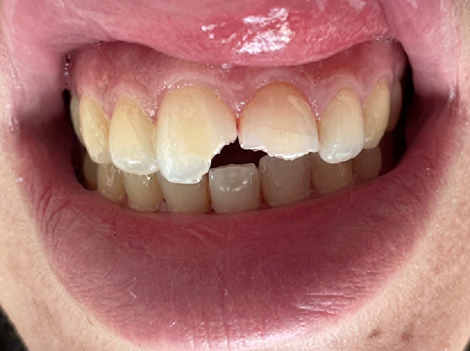 Antes — restauração estética de incisivo fracturado antes e depois Aveiro