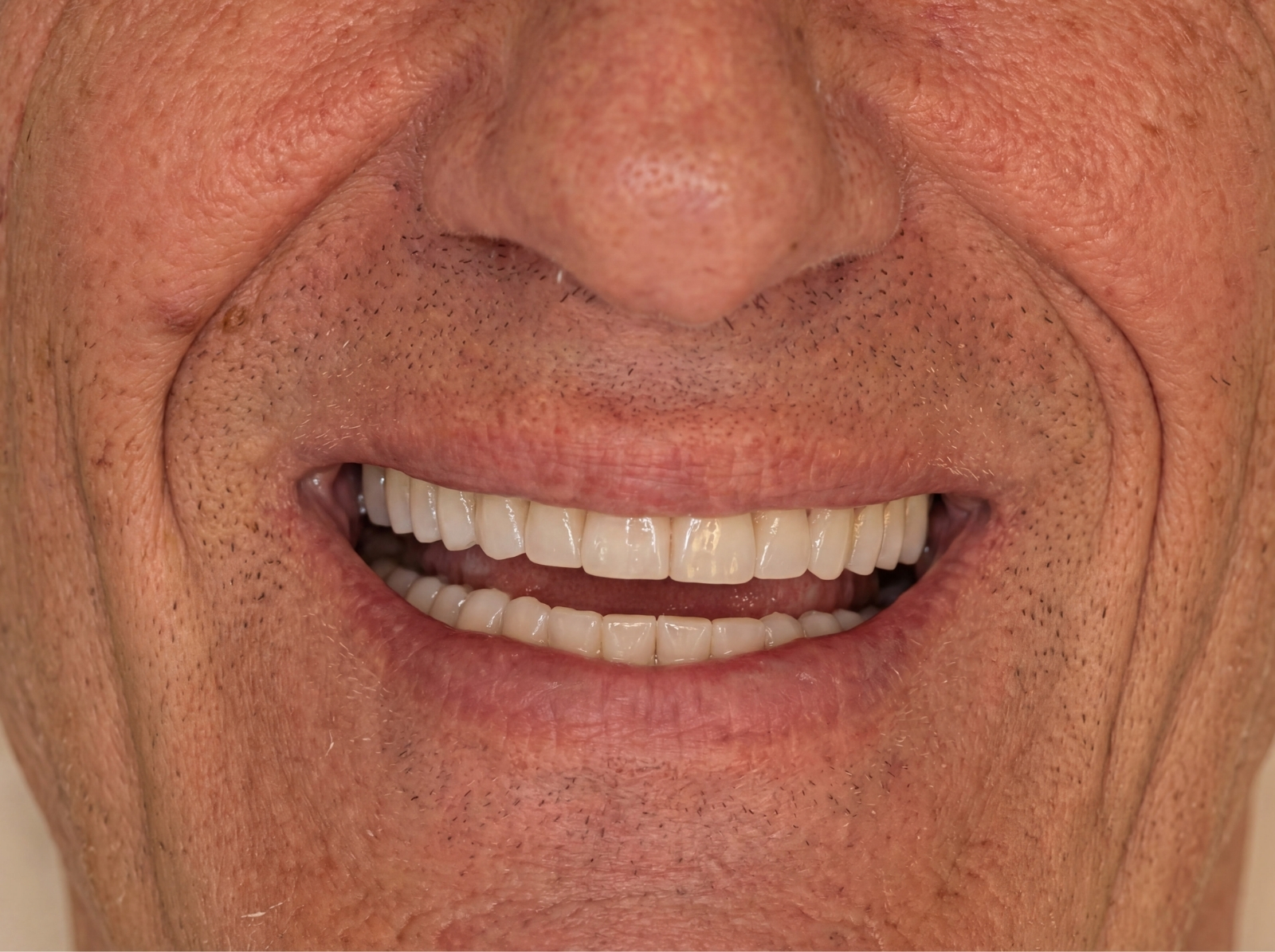 Depois — reabilitação oral completa com Dentes Fixos no Mesmo Dia antes e depois Aveiro