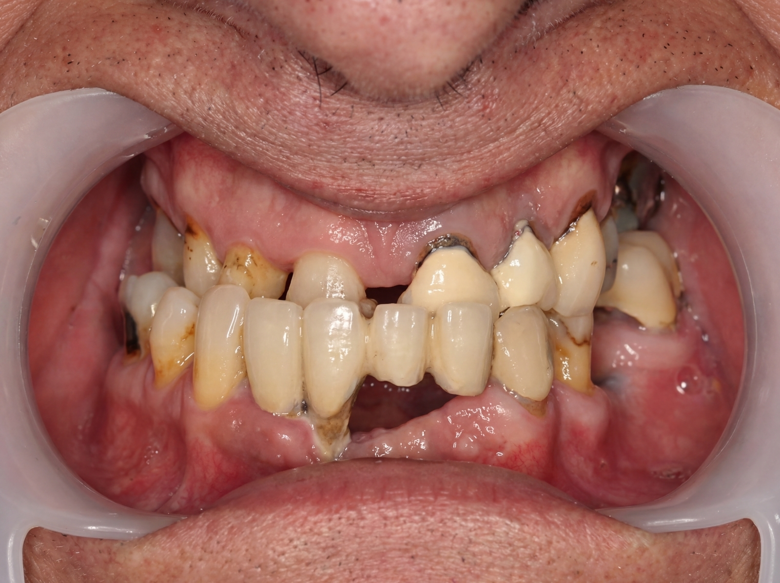 Antes — reabilitação oral completa com Dentes Fixos no Mesmo Dia antes e depois Aveiro