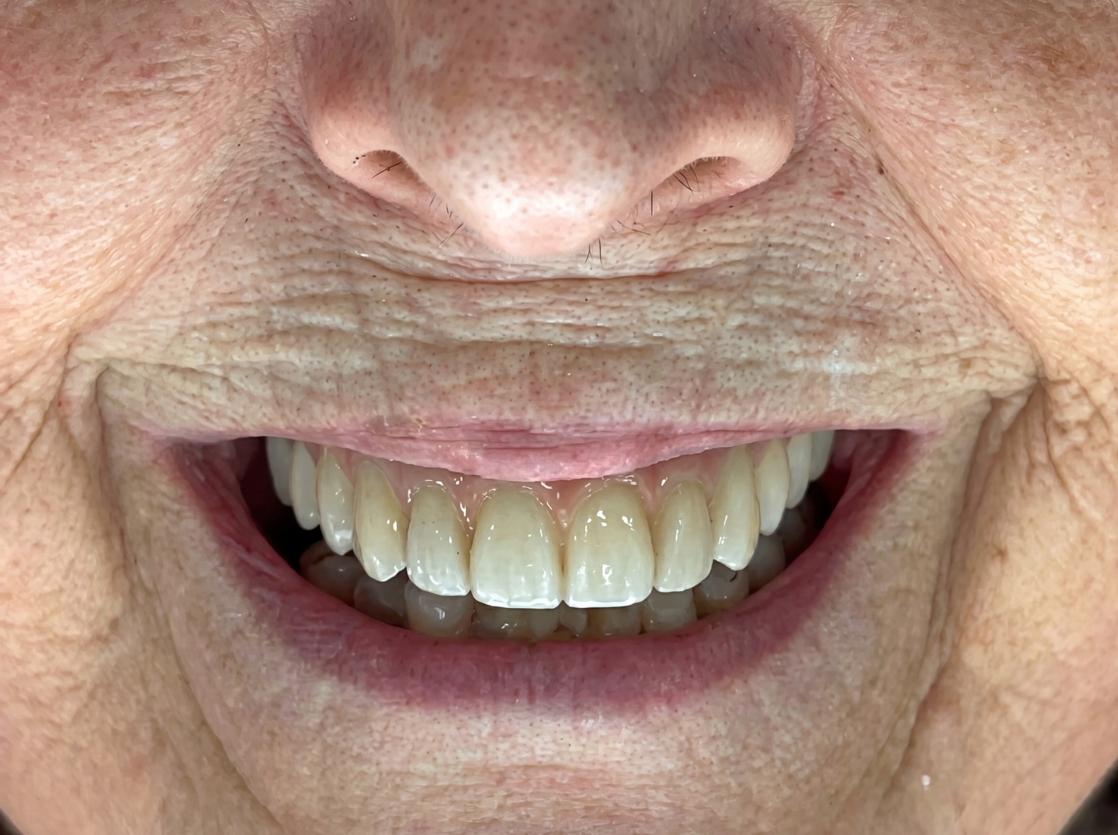 Depois — Dentes Fixos no Mesmo Dia com prótese fixa em maxilar edêntulo antes e depois Aveiro